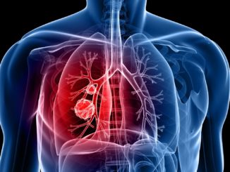 Todesrisiko bei Krebserkrankung in den USA stark gesunken