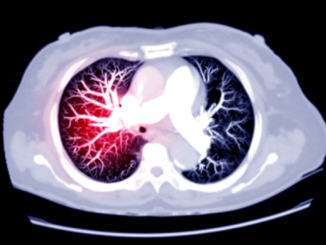 Auch sechs Monate nach Corona-Ansteckung noch erhöhtes Lungenembolie-Risiko